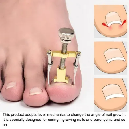 Professional ingrown toenail corrector - lifter - stainless steelEquipment