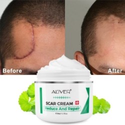 Scar removal cream - stretch marks - acne marks - face / body treatment - 50 mlSkin